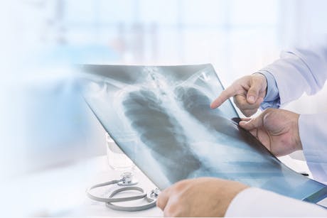 Doctors reviewing an X-ray for signs of lung cancer.